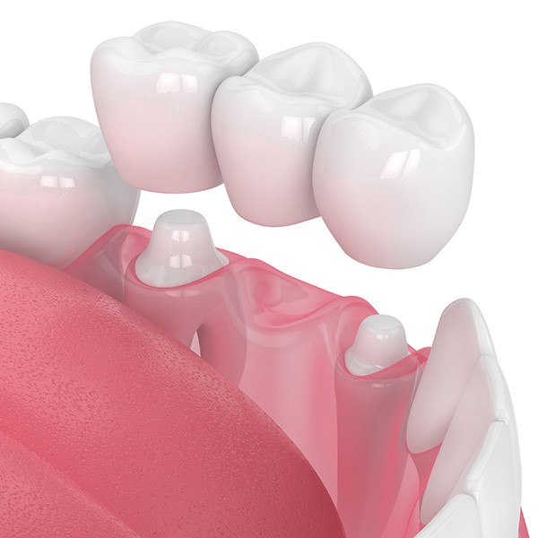 ponte suportada por dentes naturais
