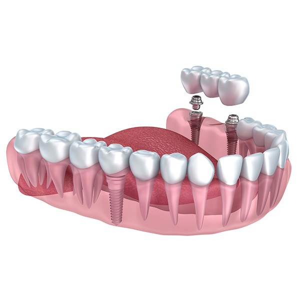 ponte suportada por implantes