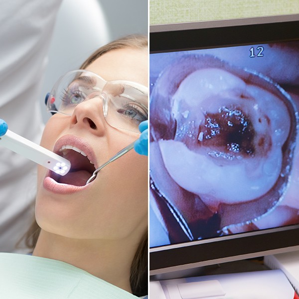 CÂMERA INTRA-ORAL